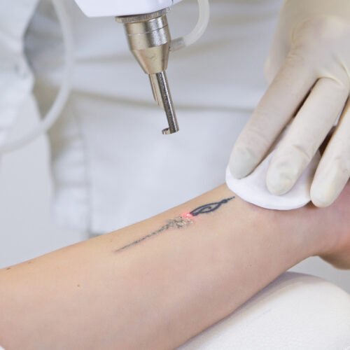 Sesión de eliminación de un tatuaje con láser